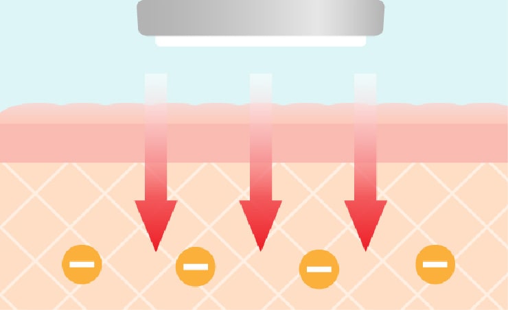 イオン導入のイメージ画像