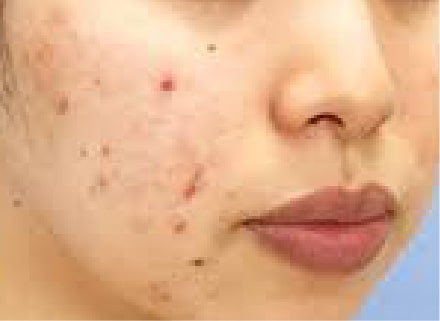 ピーリング＋イオン導入症例Before