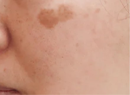 シミ取りレーザー症例Before