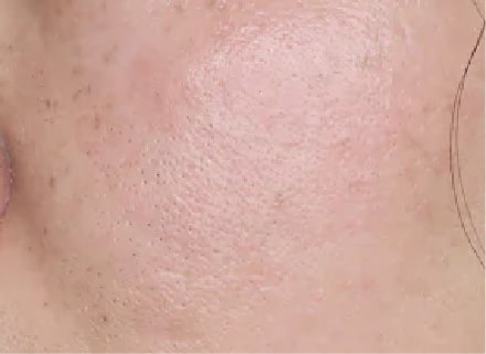 シミ取りレーザー症例After