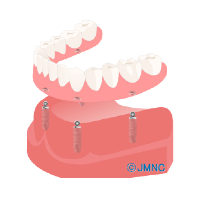 インプラントなら3
