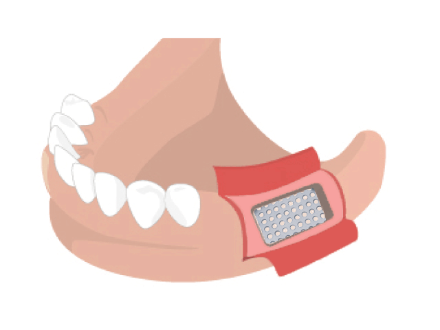 チタンプレートオペ